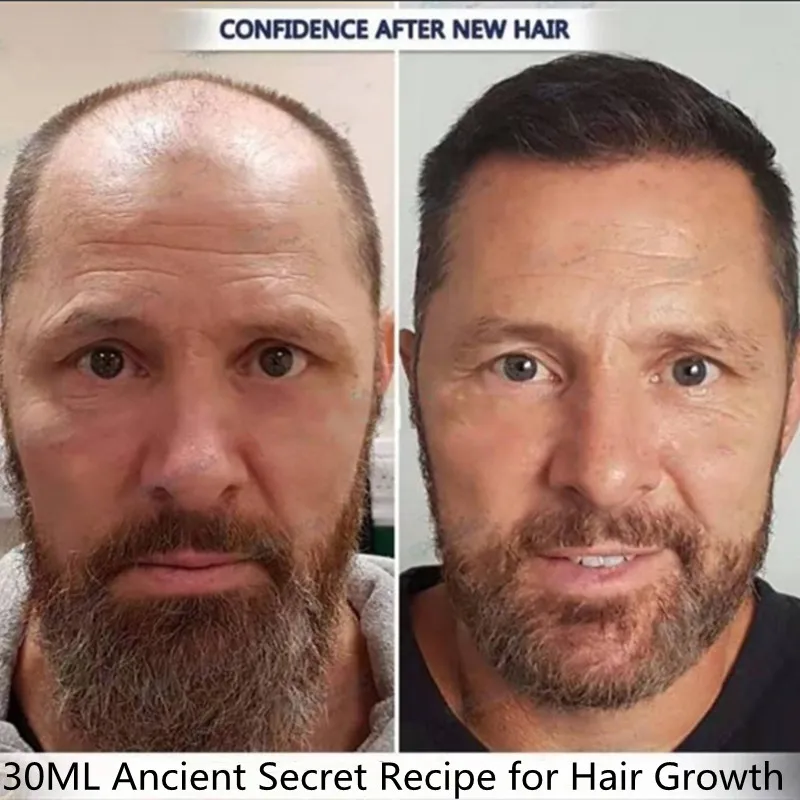 

30ML Ancient Secret Recipe for Hair Growth Treatment Hair Care Essential Oils Essence Original Authentic 100% Hair Loss Liquid