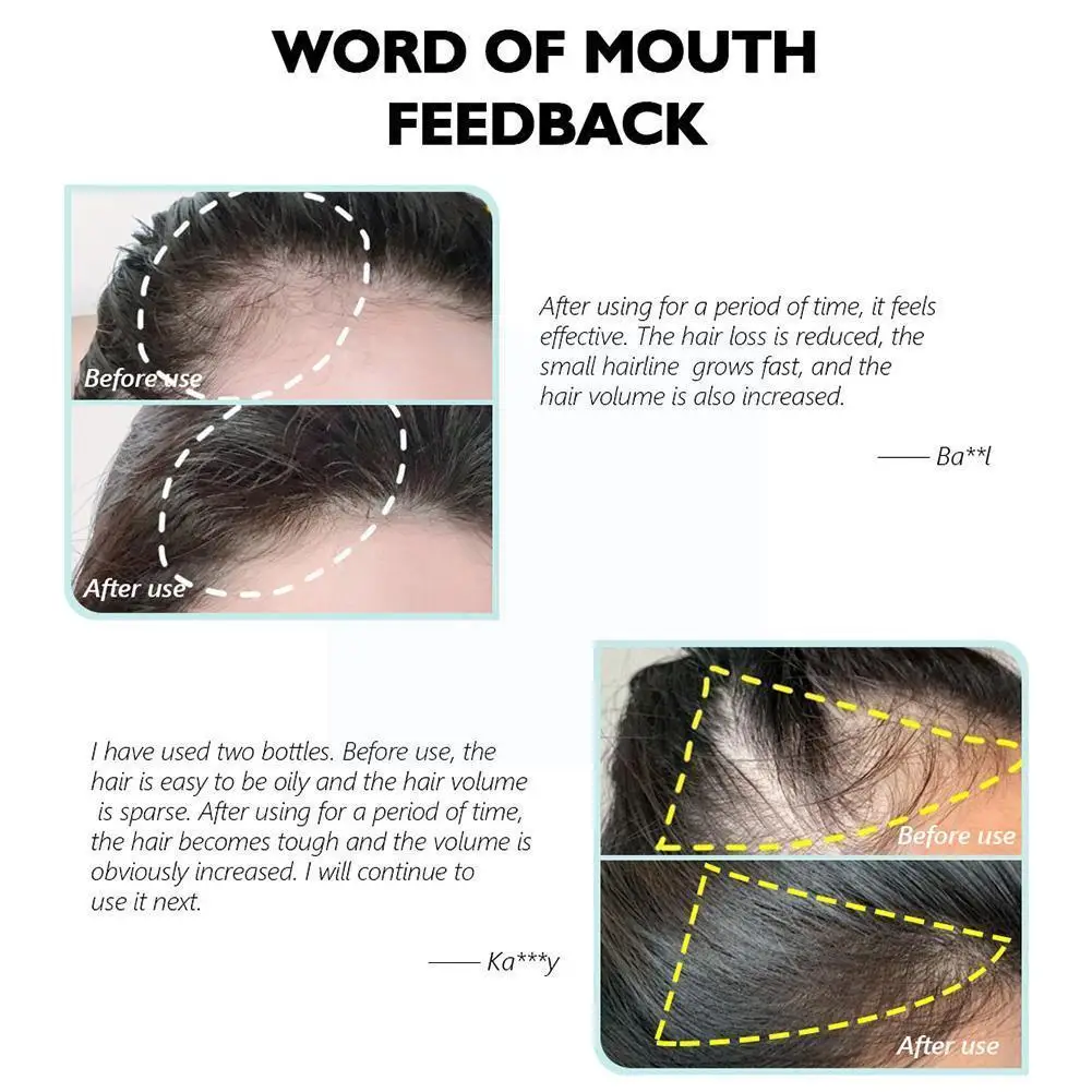 

Hair Growth Lotion 30ml Hair Treatment Hair Care Hair Essential Oil Products Prevent Hair Loss Oil Scalp Treatment For Men Q2g2