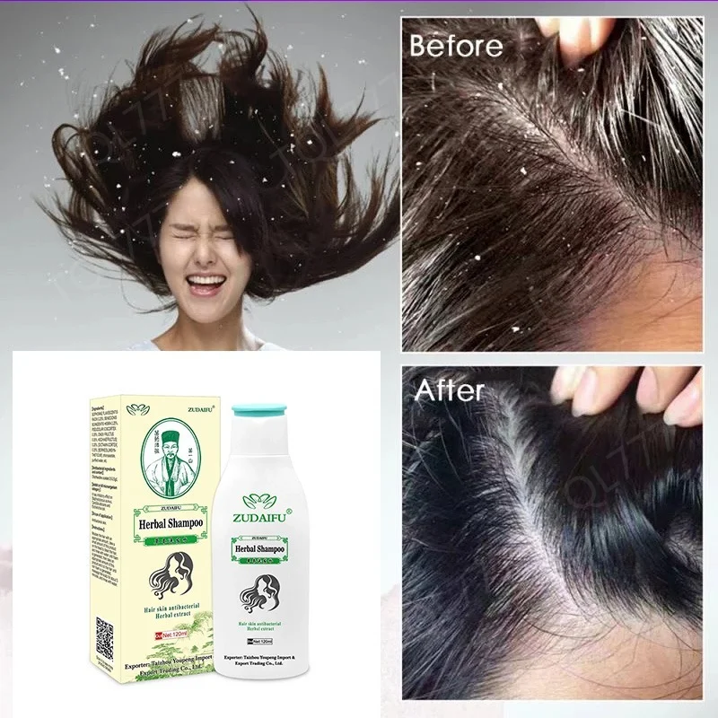 

Shampoo 120ML Hair Psoriasis Seborrheic Skin Care Treatment Dermatitis Eczema Compound Herbal Anti-dandruff Itching Shampoo