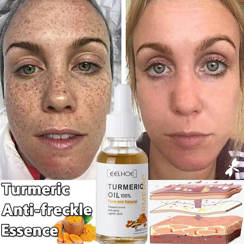 Turmeric Whitening Serum Remove Freckle Dark Spot Melasma Essential Oil Whiten Melanin Improve Dull Anti-Aging Skin Care Product