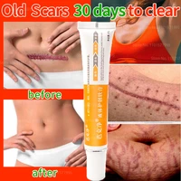 acne scar removal face cream acne spots acne pigmentation corrector anti scar stretch marks repair skin care