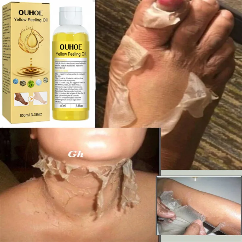 

100ML Yellow peeling oil Body Exfoliation strong Lighten elbows knees hands melanin even skin tone and whiten skin