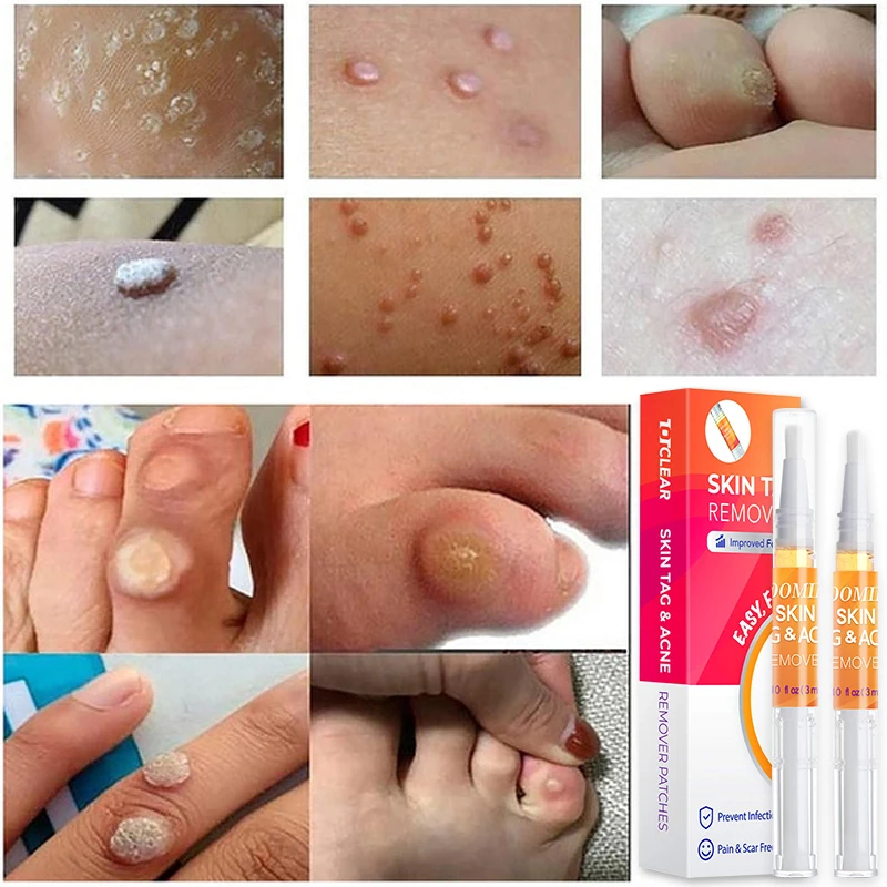 Флуоресцентная ручка для удаления бородавок с кожей жидкая лечения папилломы 1