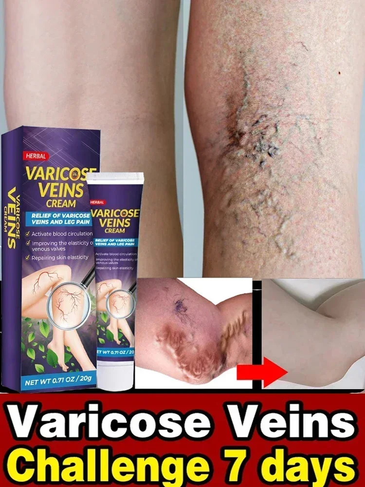 Лечение Варикозного расширения вен облегчение боли в ногах васкулит флебит паук