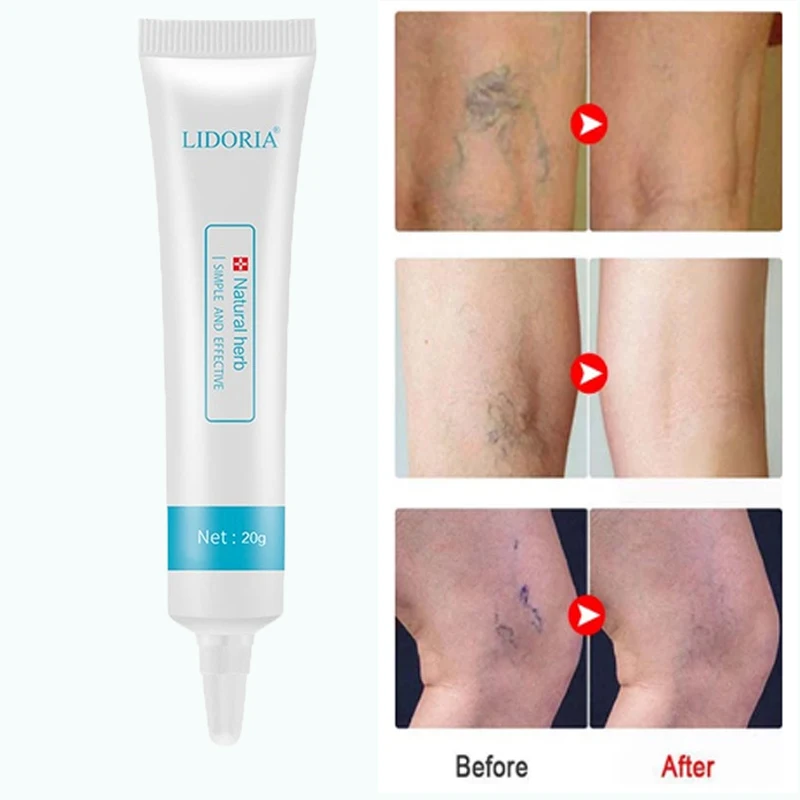 

Varicose Veins Relief Repair Cream Vasculitis Phlebitis Pain Relief Cream Ointment Body Care 20g