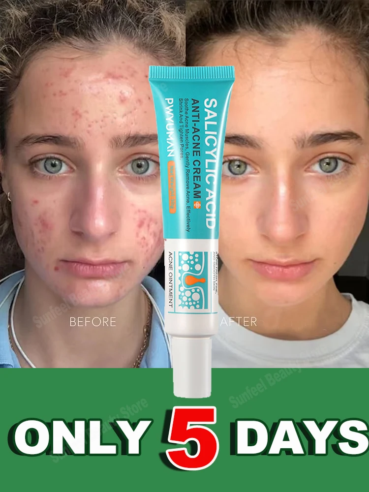 Салициловая кислота крем для лечения прыщей гель восстановления против