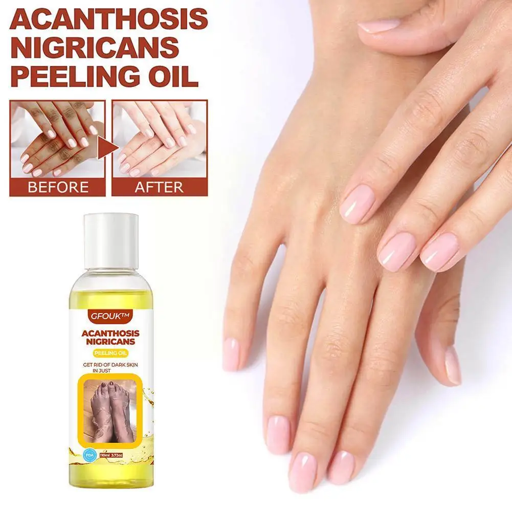 

30/110ml Yellow Peeling Oil Acanthosis Nigricans Therapy Even Spot Knees Hands Dark Whitening Care Tone Effective B Z6P8