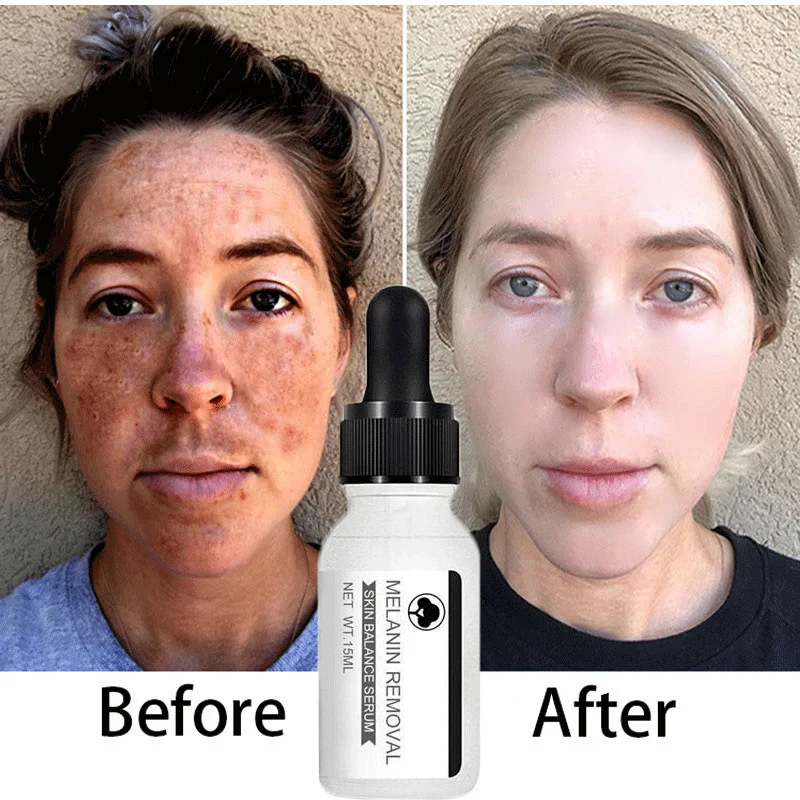 

Niacinamide Whitening Freckle Face Serum Remove Melasma Dark Spots Pigment Melanin Anti-Aging Correcting Brighten Skin Care 15ml