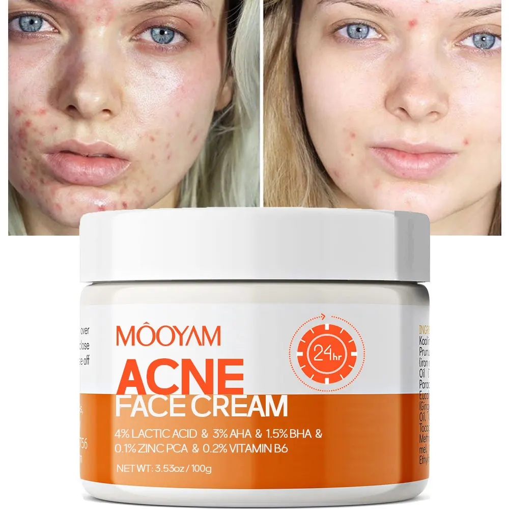 100ml Effective Acne Removing Cream for Acne Scar Shrinking Pore Oil Controlling Whitening Moisturizing Facial Skin Care 1pcs