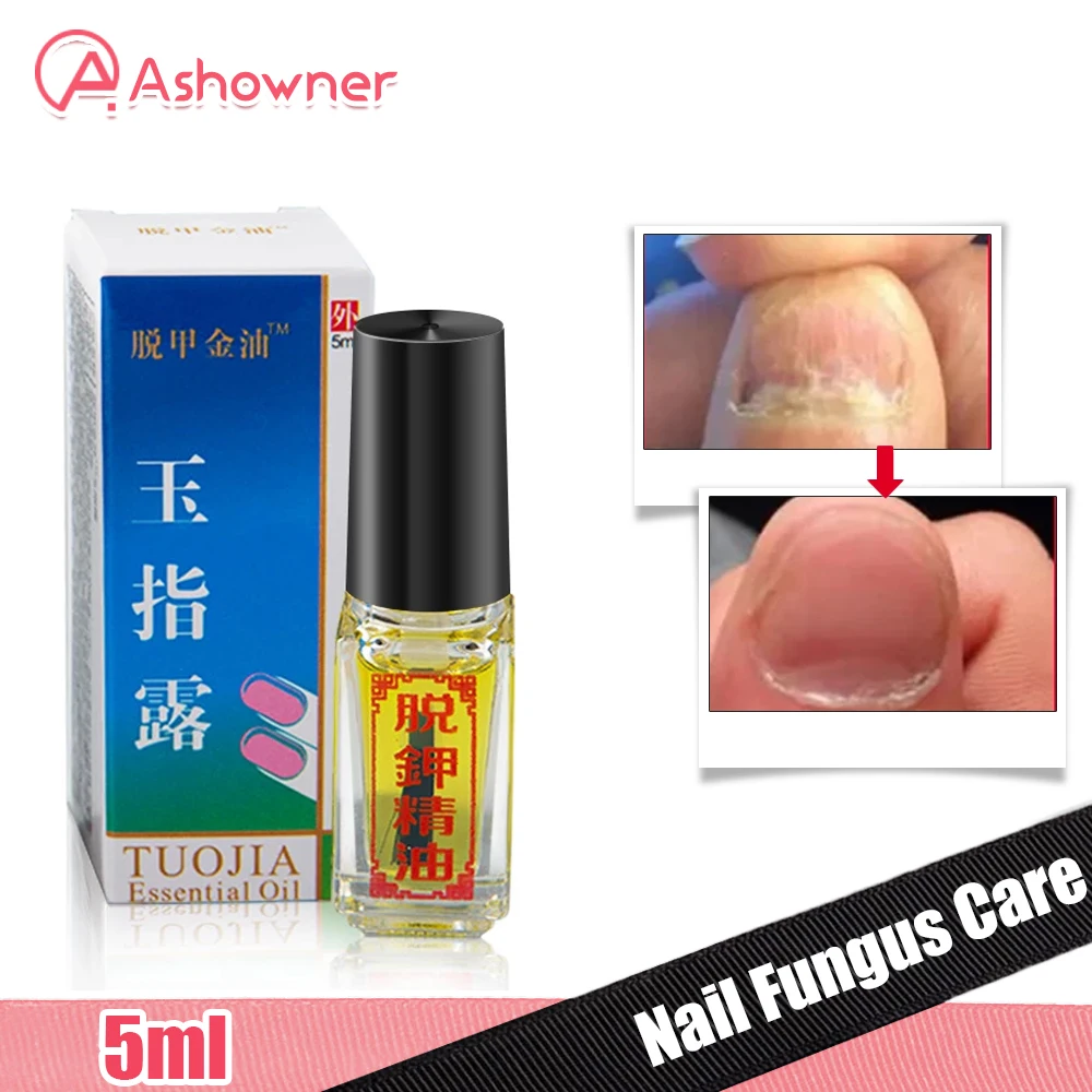 

Toe Nail Treatment Fungus oil Care Nail Fungus Liquid Effect Paronychia Anti Infection Removal Foot Caring Onychomycosis Repair