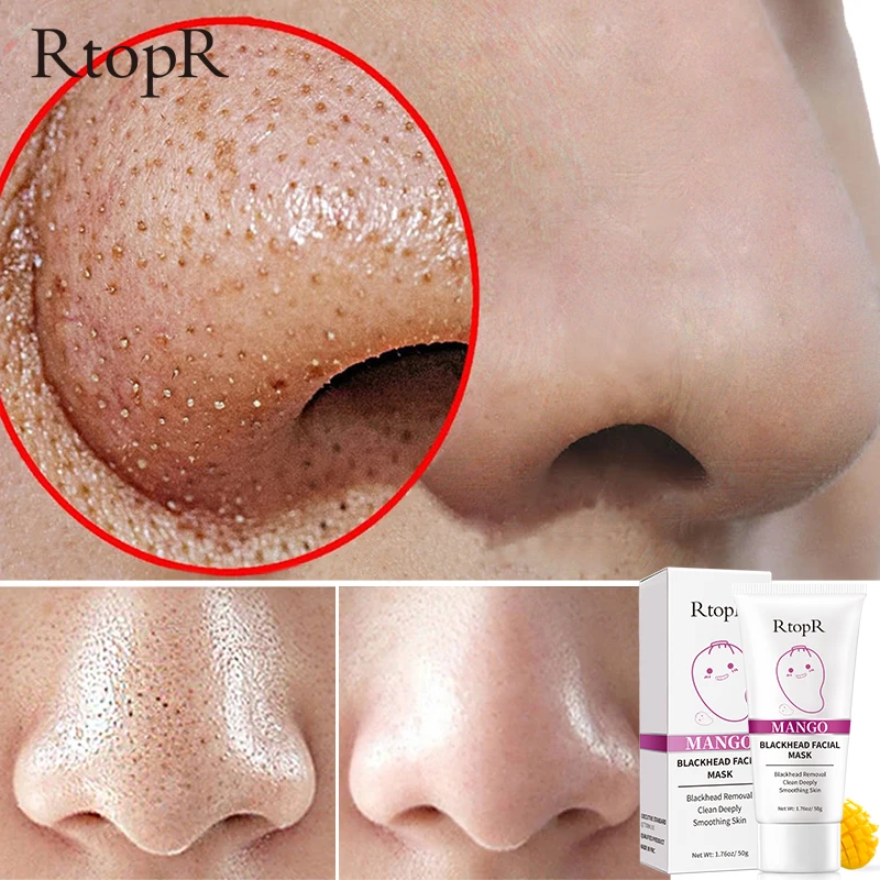 

Маска для лица RtopR, с манго, для глубокого пилинга, лечения угрей, ухода за глубокое очищение кожи