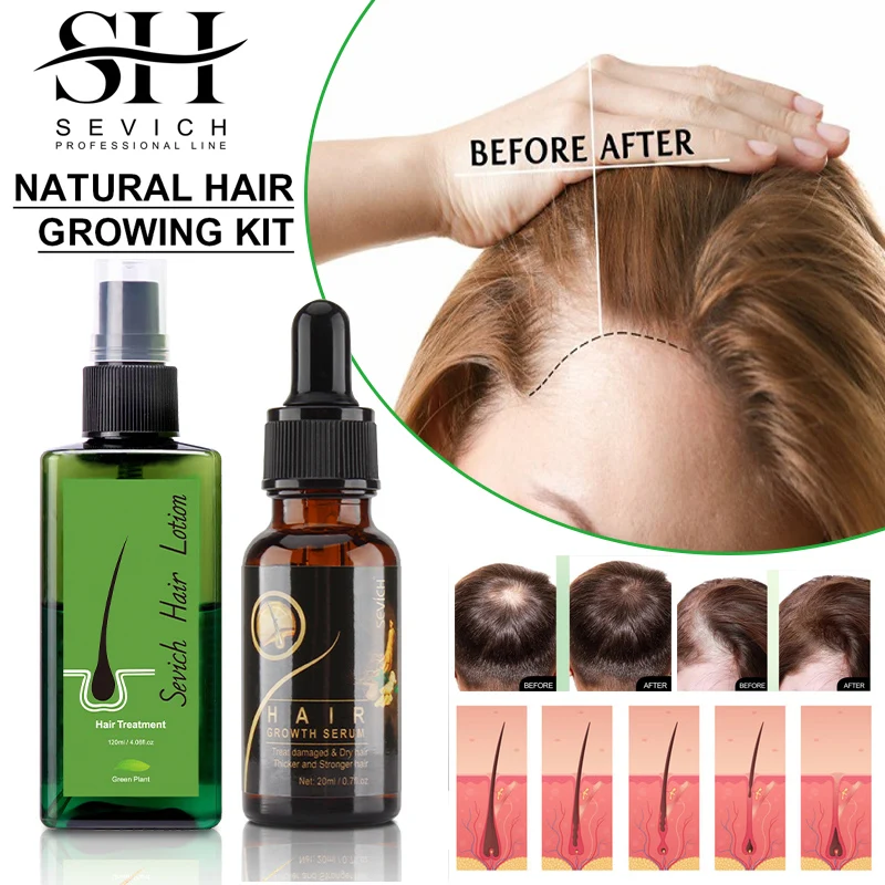 

Sevich Fast Hair Growth Serum Set Natural Ginger Hair Growth Products Anti Hair Loss Spray Biotin Hair Care For Men Women 2pcs