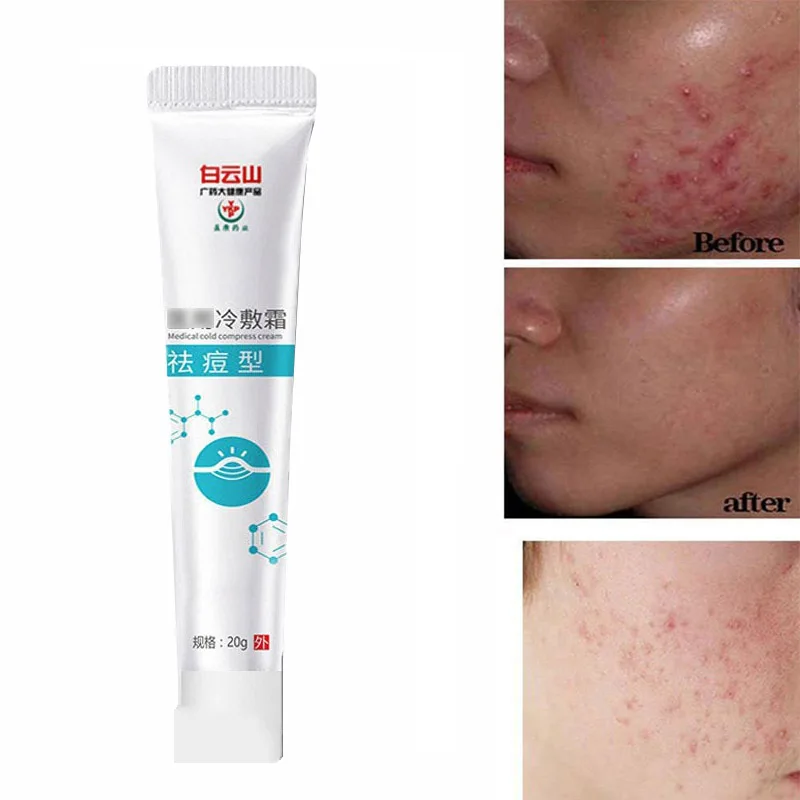 

Cold Compress Cream Acne Removing Cream Herbal Mild Acne Removing Face Cream