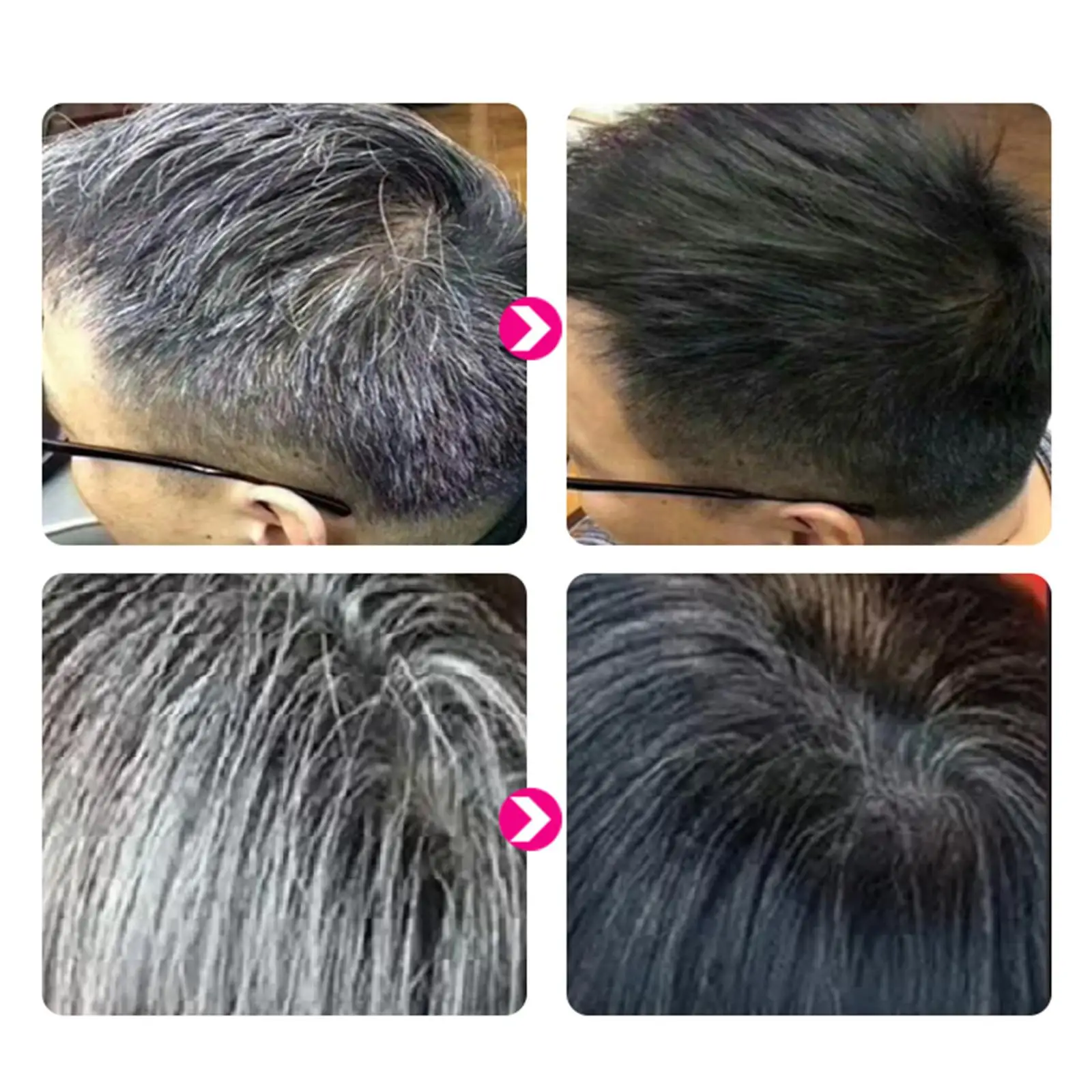 2023 Сыворотка для роста волос против выпадения Alopecia жидкость истончения