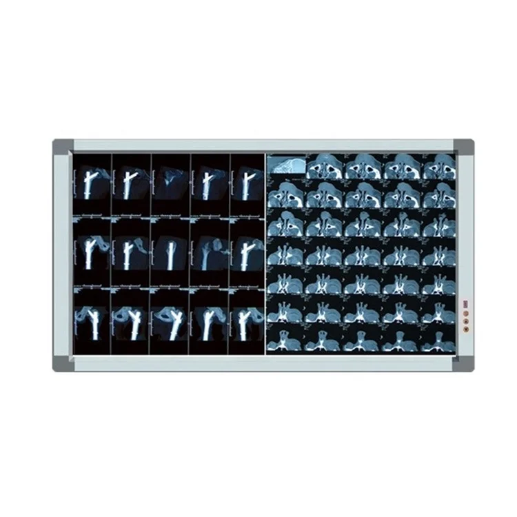 

Negatoscope radiology medical equipment double bank X-ray film viewer