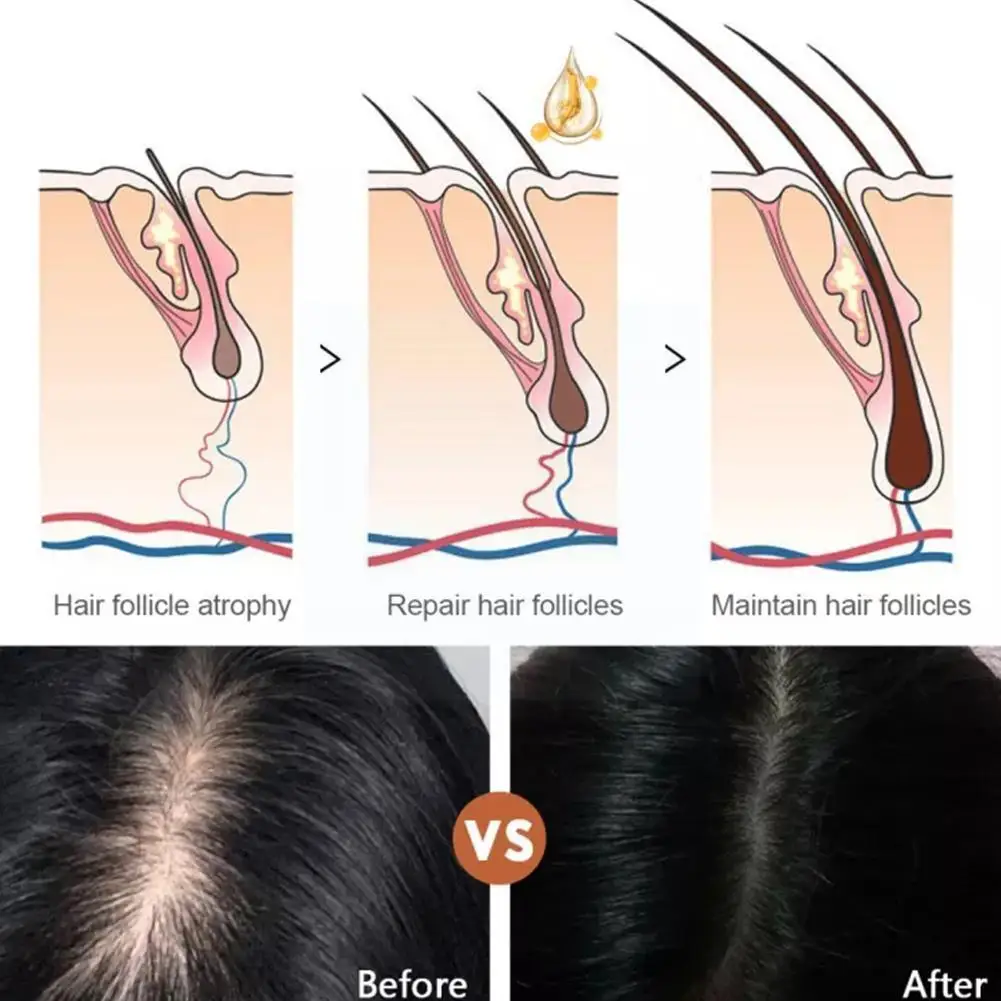 

Эссенция для роста волос A5K0, натуральный спрей для выпадения волос, лечение и быстрое выпадение, эффективное питание волос, 30 мл