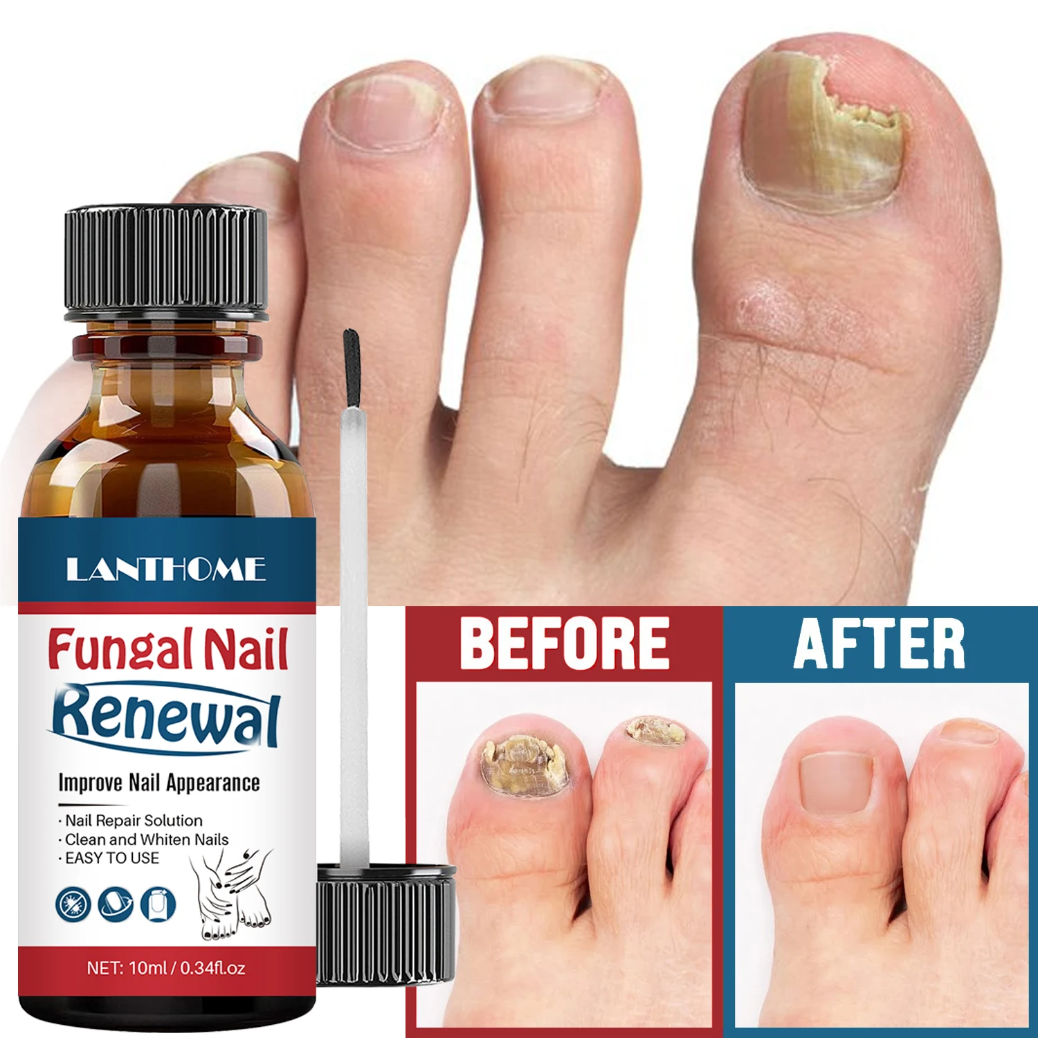 

Nail Fungal Treatment Feet Care Essence Anti Infection Paronychia Onychomycosis Foot Toe Nail Fungus Removal Gel