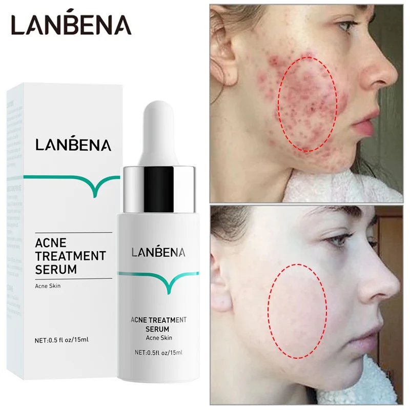 

LANBENA Salicylic Acid Acne Removal Serum Anti-Acne Repair Fade Acne Spots Pimple Oil Control Cream Whitening Moisturizing Skin