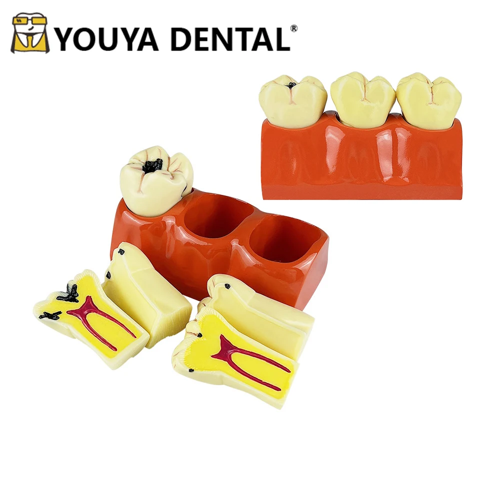 

Teeth Model 4 Times Caries Developing Teaching Model For Dentist Student Demonstration Module Practice Training Studying