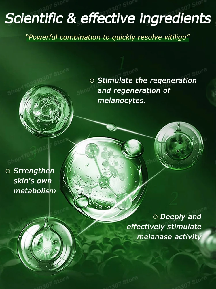 Blu-Ray Pen Vitiligo быстро улучшает белые пятна