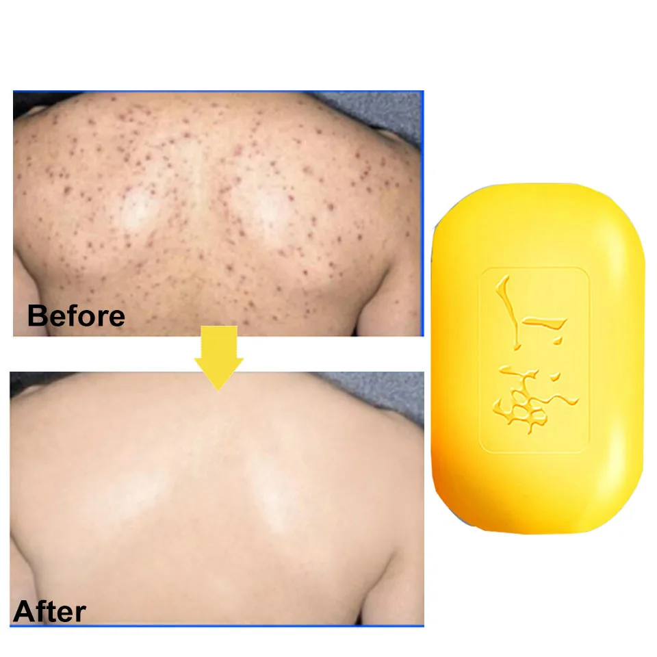

2pcs 85g Shanghai Sulfur Soap Acne Treatment Blackhead Remover Soap Whitening Cleanser Oil-control Chinese Traditional Skin Care