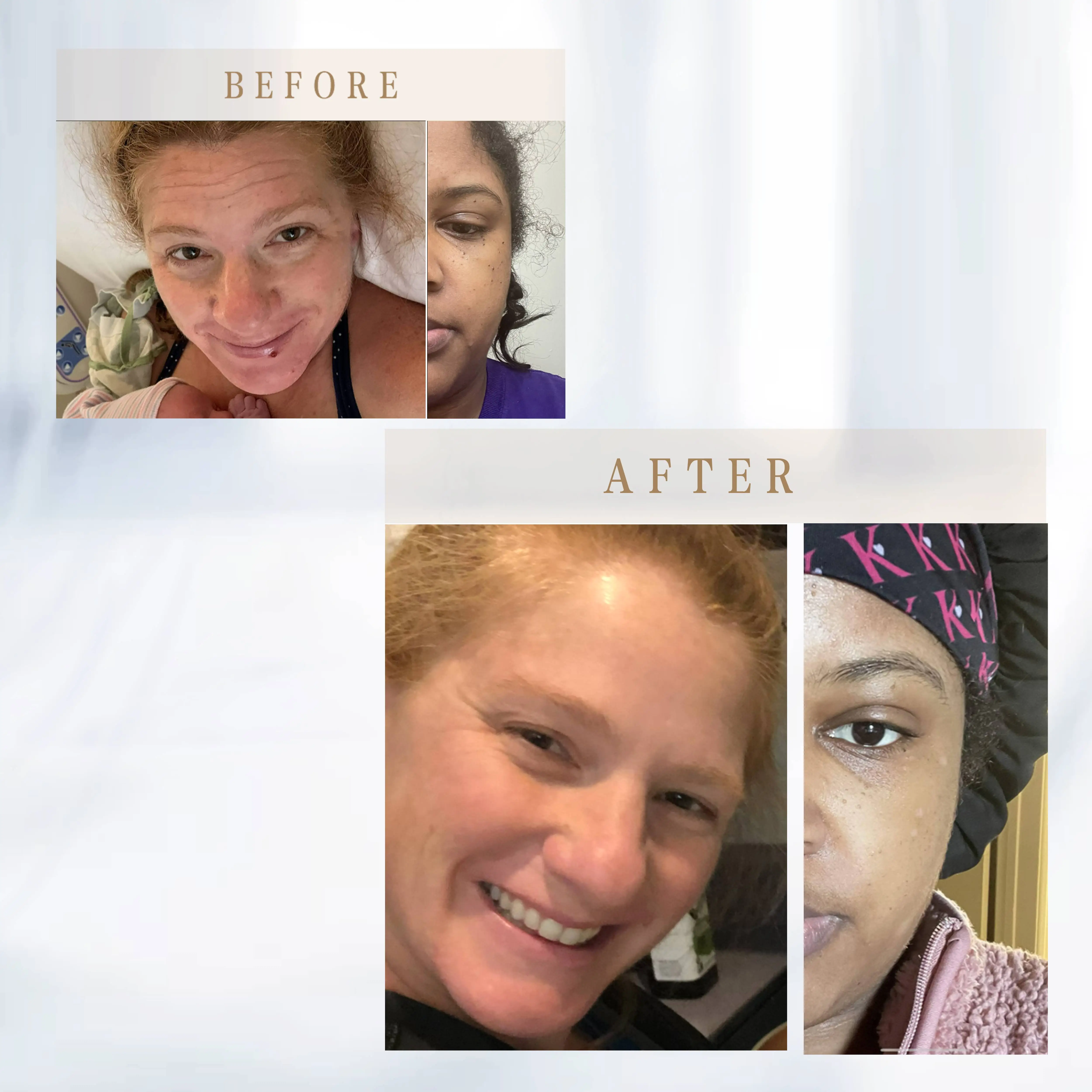 Озонирующая плазменная ручка Plamax для удаления веснушек черных точек |