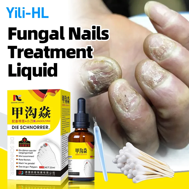 Средство для лечения грибков ногтей средство очистки паронихии коррекции грибка