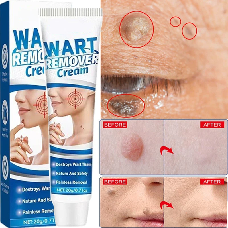 

20g Painless Skin Tag Remover Cream Mole Skin Dark Spot Warts Remover Ointment Freckle Face Wart Tag Treatment Removal Cream