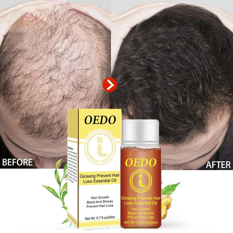 

Ginseng Hair Growth Essential Oil Preventing Hair Loss Repair Damage Prevent Frizzy Hair Serum Nourish Root Beauty Health Care