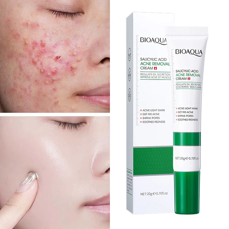 Acne Treatment Face Cream Natural Pimple Scar Removal Shrink Pore Oil Control Moisturizing Skin Care Facial Repair Beauty Health