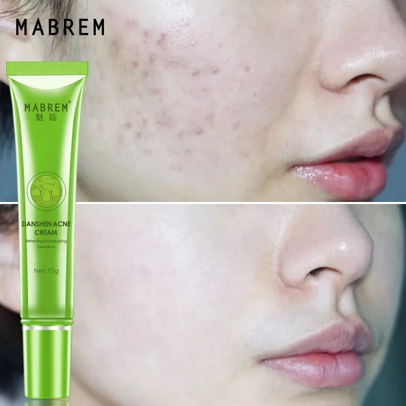 

MABREM Acne cream lighten acne oil control Shrinking pores whitening and moisturizing acne cream Scar removal Skin care