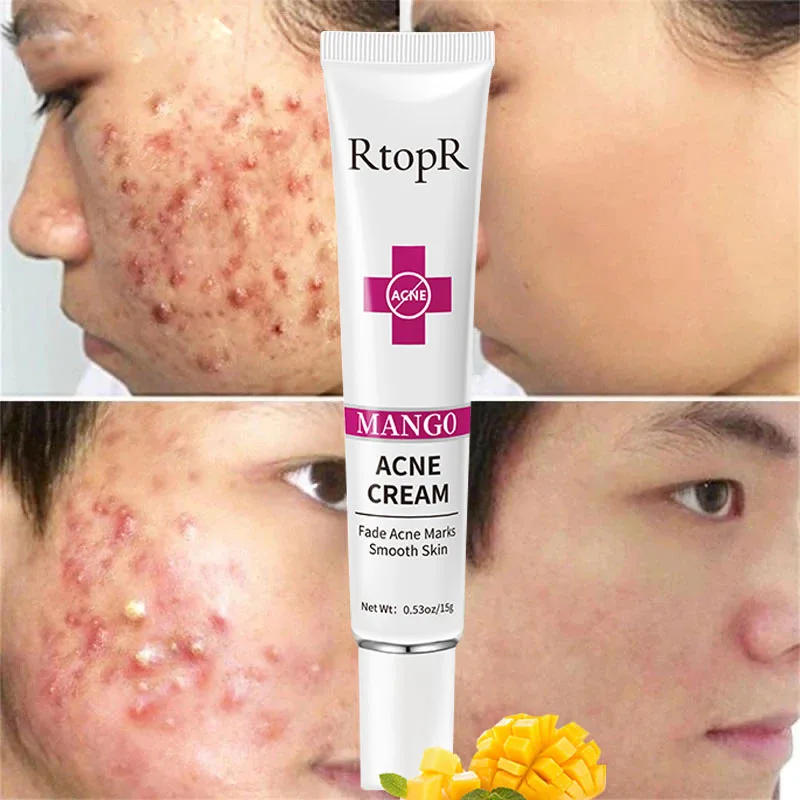 

RtopR Anti-acne Facial Cream Gel Pimple Remover Acne Scar Remedy Anti Dark Spot Ointment Nourishing Acne Treatment Face Care