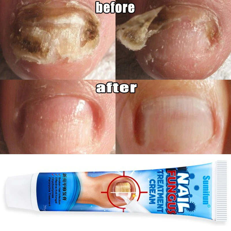 

Sdotter 1pcs Fungus Nails Treatment Gel Onychomycosis Paronychia Anti Infection Cream Hand Foot Care Toenail Repairing Fungal Re