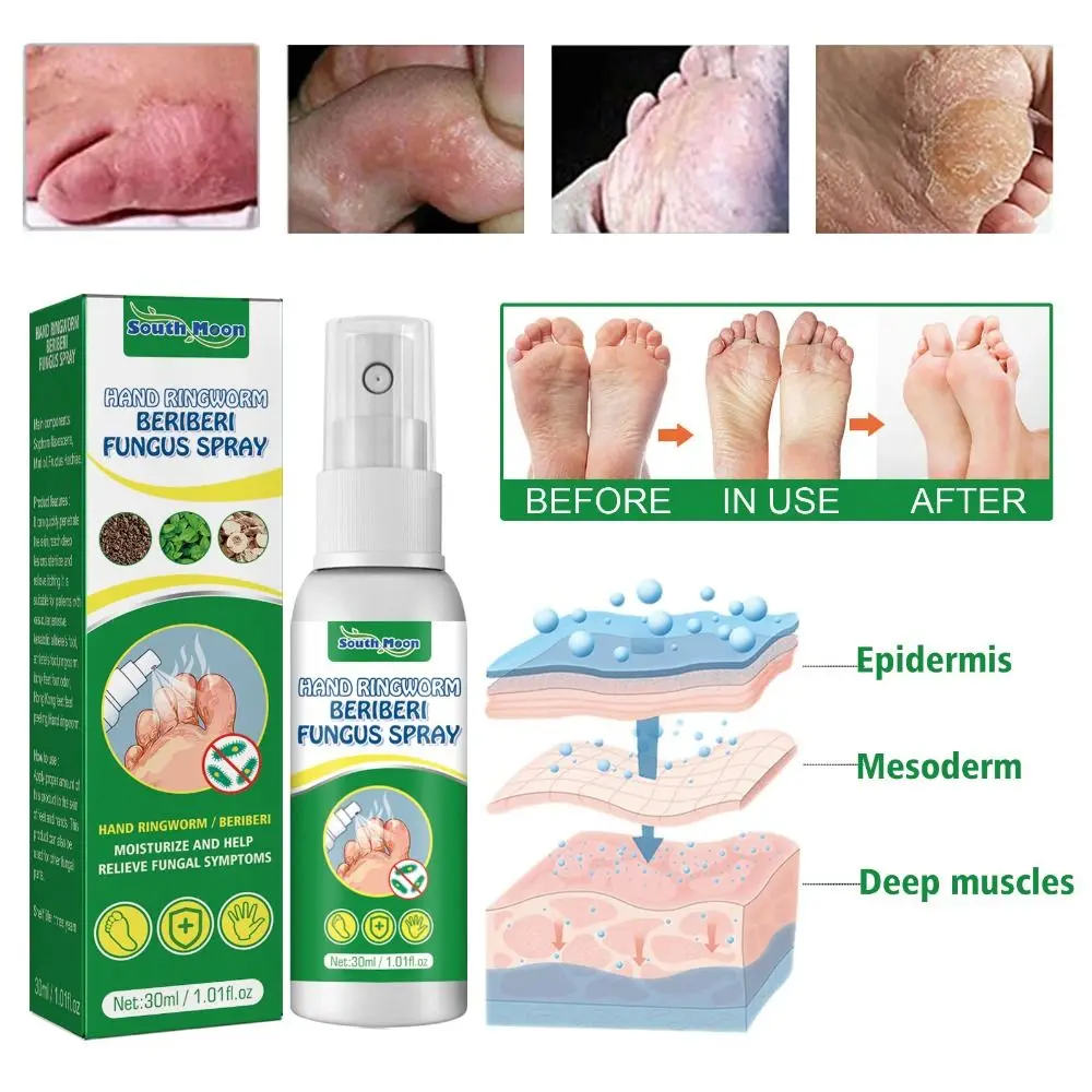 

Восстанавливающий кожу Антибактериальный Eczematoid псориаза травяная мазь спрей для кожи спрей для псориаза дерматита