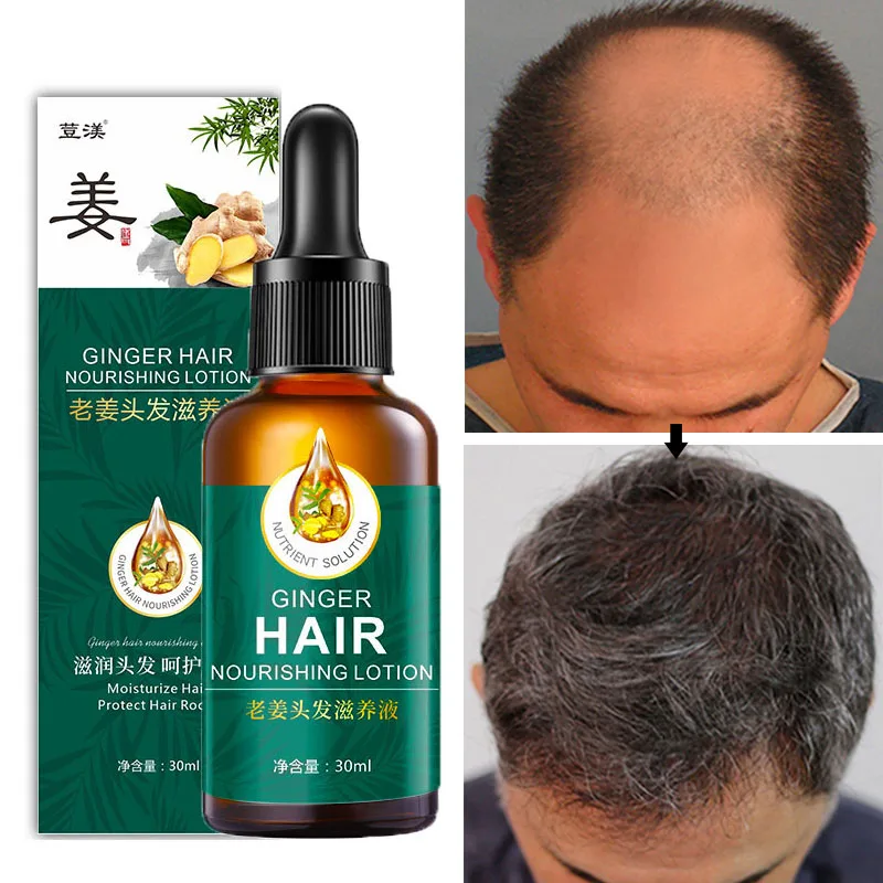 30ml Ginger Hair Growth Essential Oil Anti Lost Hair Treatment Products Repair Scalp Frizzy Damaged Prevent Hair Thinning Serum