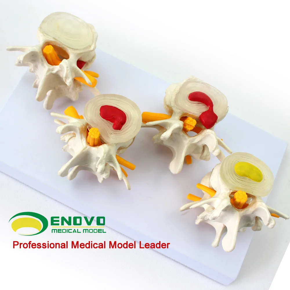

Enovo Yinuo Medical Combination Model Of Normal Lumbar Lesions Bone Model For Teaching In The Department Of Intervertebral Disc