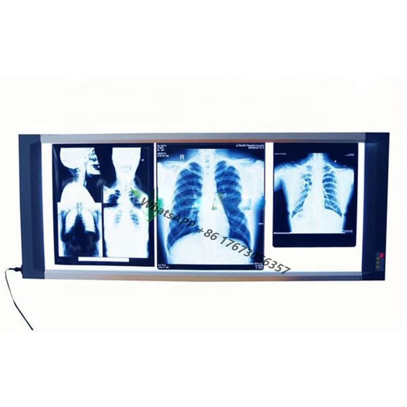 

Xray Negatoscope Lamp Digital CR X Ray View Box Medical Mammography X-ray Film Viewer