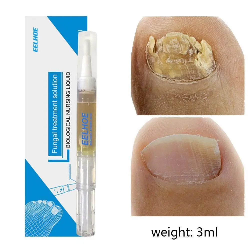 

3ml Anti Fungal Treatment Nail Pen Onychomycosis Paronychia Health Infection Herbal Nails Care Chinese Finger X8Z8