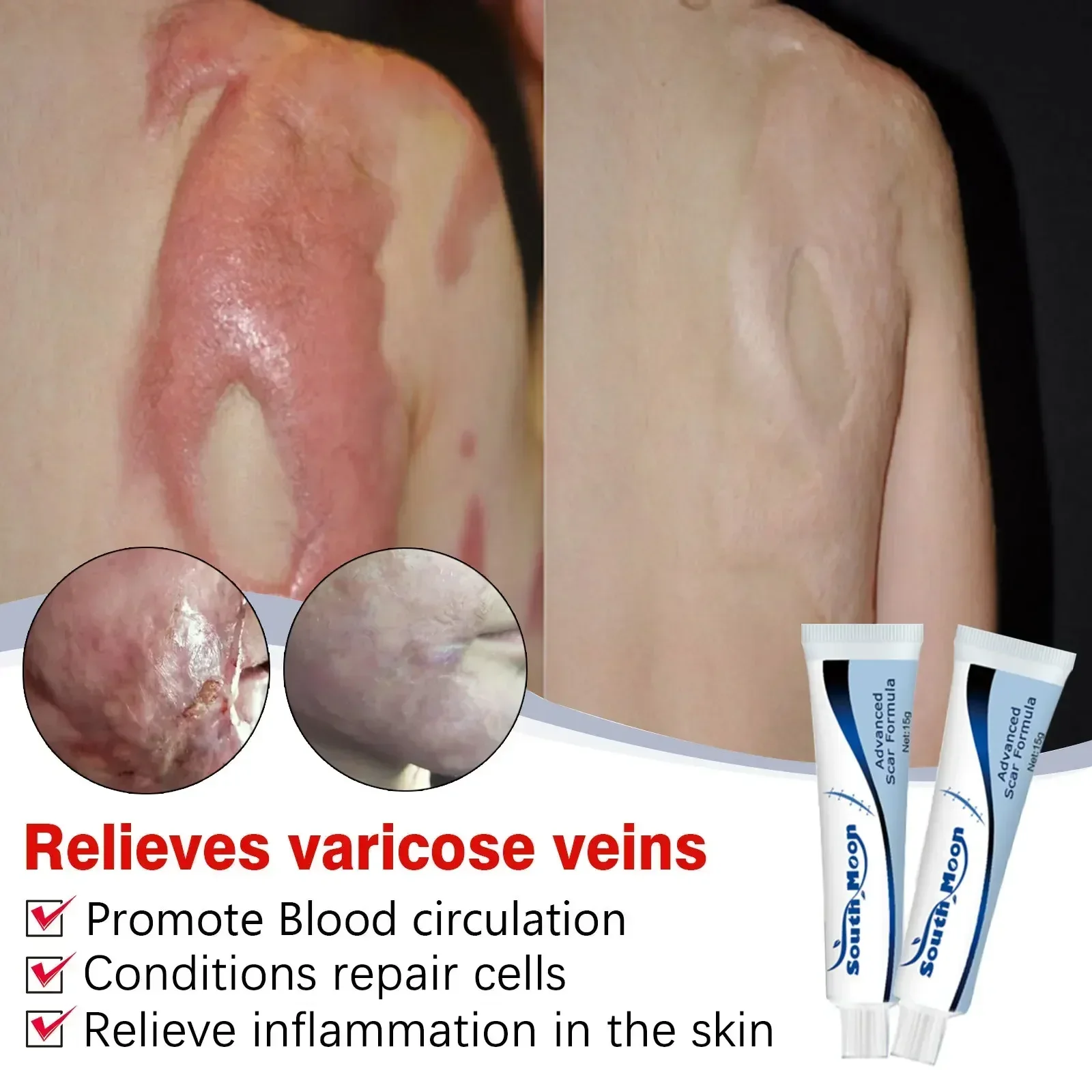 Крем для удаления шрамов со старыми шрамами новинка шрамы хирургические