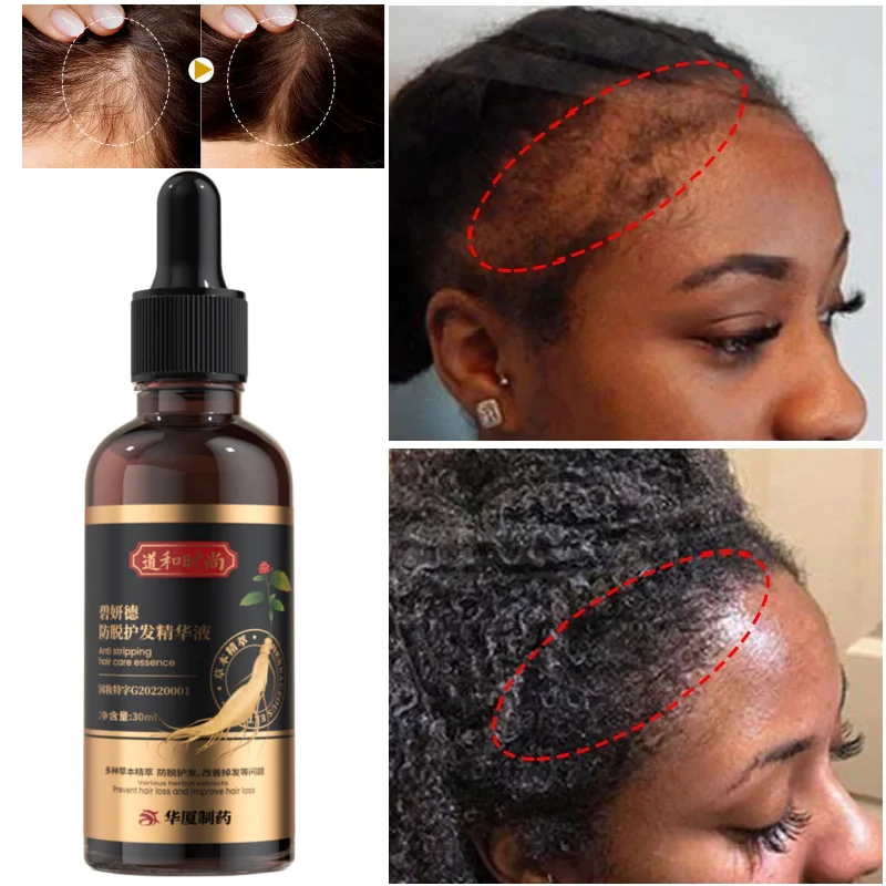 

Fast Hair Growth Anti Hair Loss Serum Effective Hereditary Baldness Treatment Scalp Repair Essential Oil Shiny Nourish Care 30ML