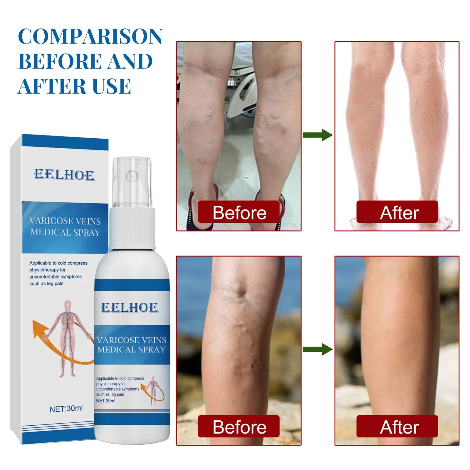 Венозный массажный спрей для облегчения варикозного расширения вен