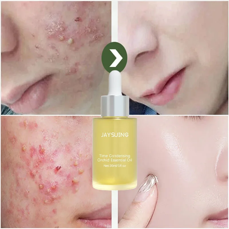 

Fast Acne Treatment Face Serum Anti Pimples Spots Scars Removal Essence Shrink Pores Oil Control Repair Skin Care Products 30ML