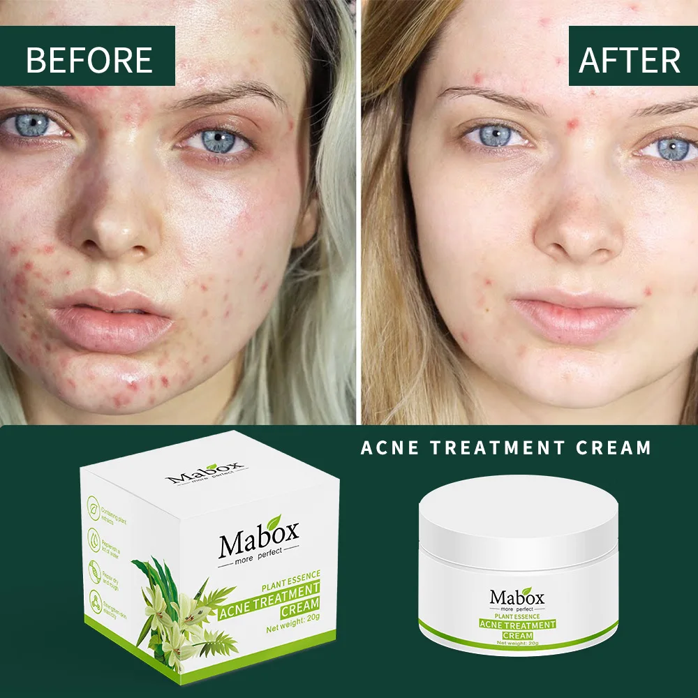 Acne Cream Essence Cream Fade Acne Muscle Acne Marks Gentle Soothing Repair Cosmetics Skin Care Facial Care
