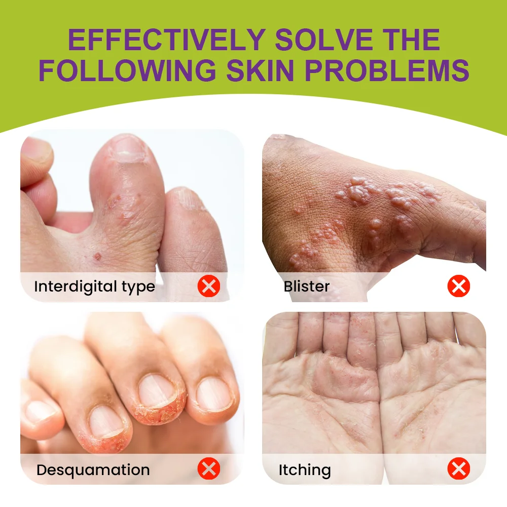 1/3/5/10/20 шт. крем для лечения герпеса пота снимает сверх кожи антибактериальная