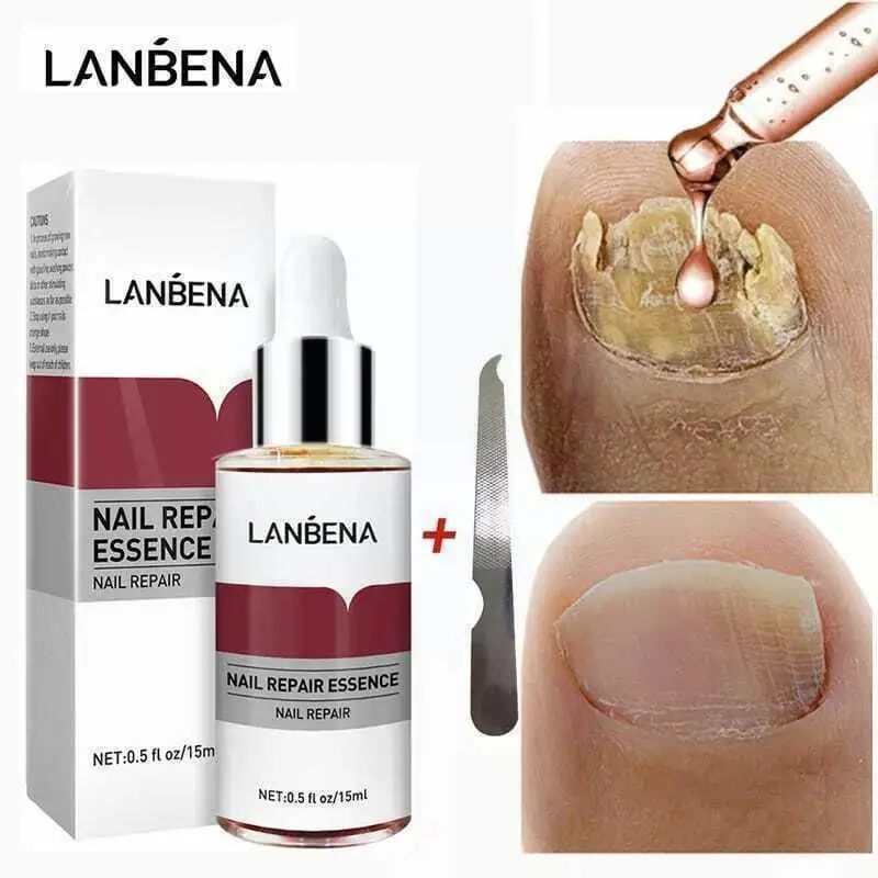 

LANBENA Fungal Nail Treatment Feet Care Essence Removal Serum Healthy Infection Anti Repair Paronychia Onychomycosis Fungus H4O5