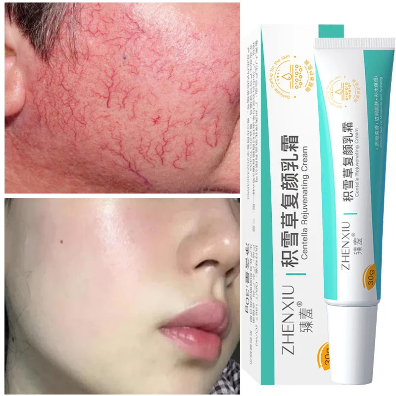 

7 Day Repair Facial Redness Cream Soothing Redness Repair Skin Rosacea Red Blood Improve Sensitive Skin Care Korean Cosmetic