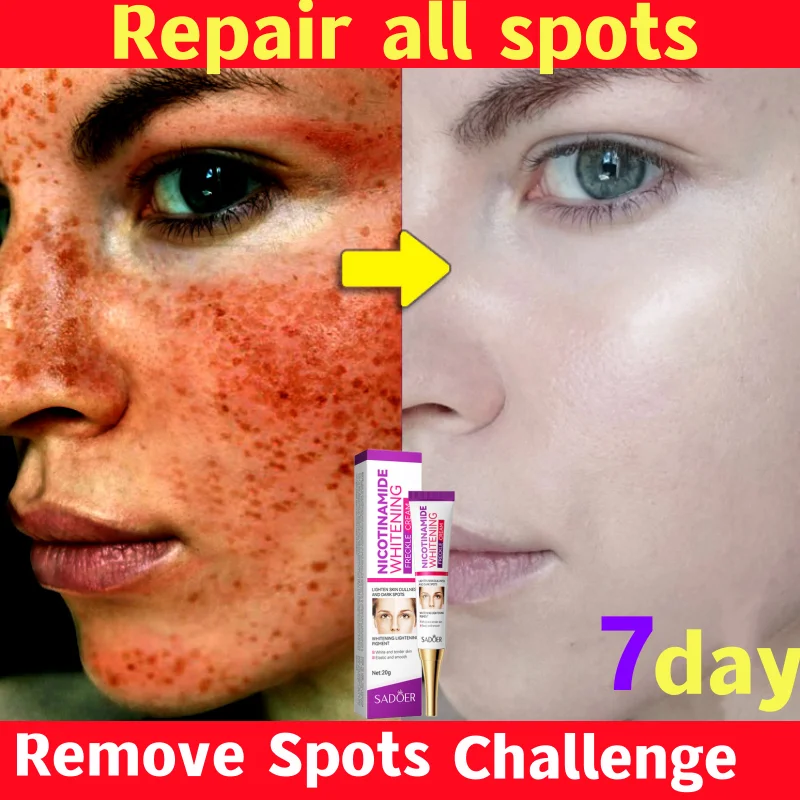 Powerful Nicotinamide Whitening Freckle Remover Cream Anti Brown Dark Spot Lighten Melasma Melanin Face Brighten Korean Skincare