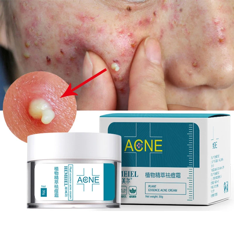 30ml acne-removing cream herbal conditioning acne-removing muscle acne-removing acne marks moisturizing repair cream
