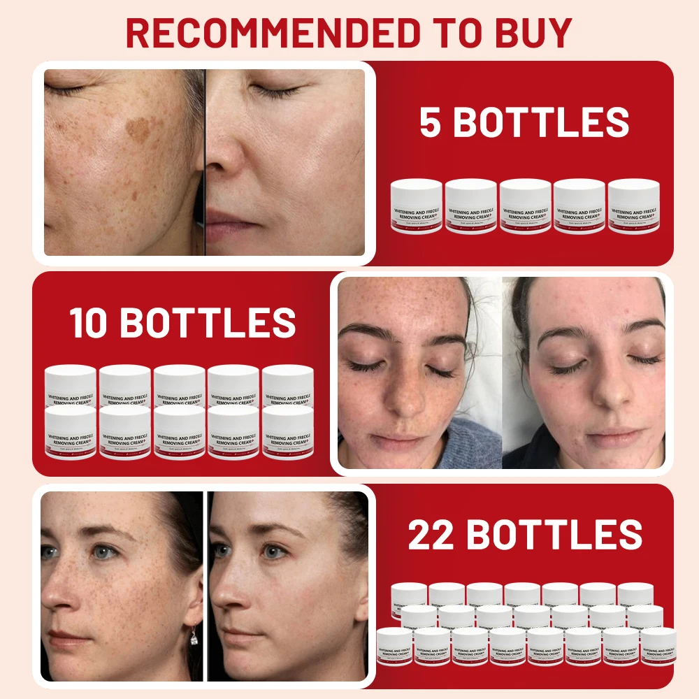 Отбеливающий и крем против веснушек удаляет темные пятна солнечные