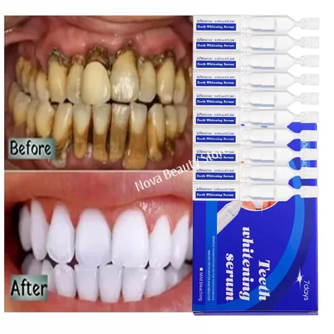 Отбеливание зубов, зубная паста, сыворотка, удаление пятен налета, гигиена полости рта, чистка, инструменты для отбеливания зубов, свежее дыхание, инструменты для ухода за зубами